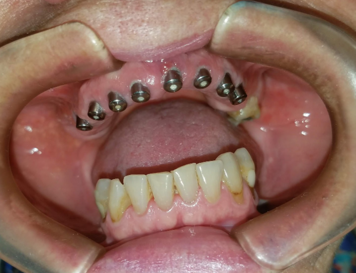 Implantes dentales.