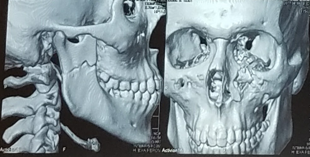 Traumatología facial y maxilar
